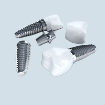 Dental Implants Image
